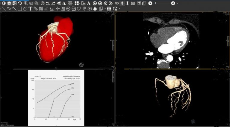 Angio coronary